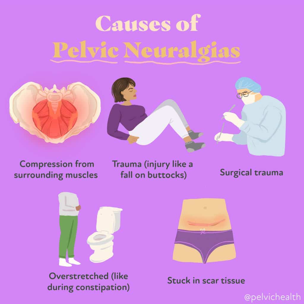 causes of Pelvic Neuralgias