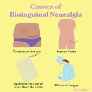 causes of ilioinguinal neuralgia