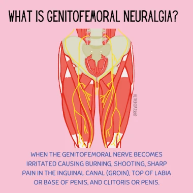 Genitofemofral neuralgia