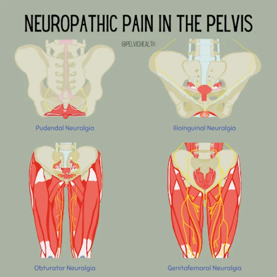 Neuropathic pain in the pelvis