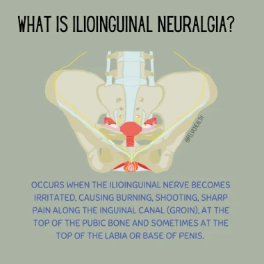 ilioinguinal neuralgia
