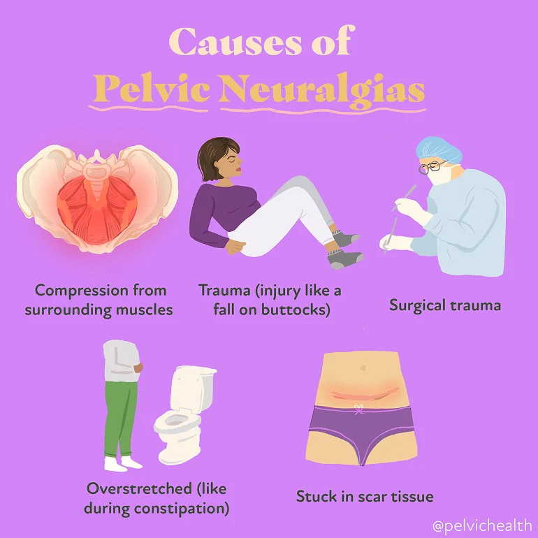 Causes-of-Pelvic-Neuralgias