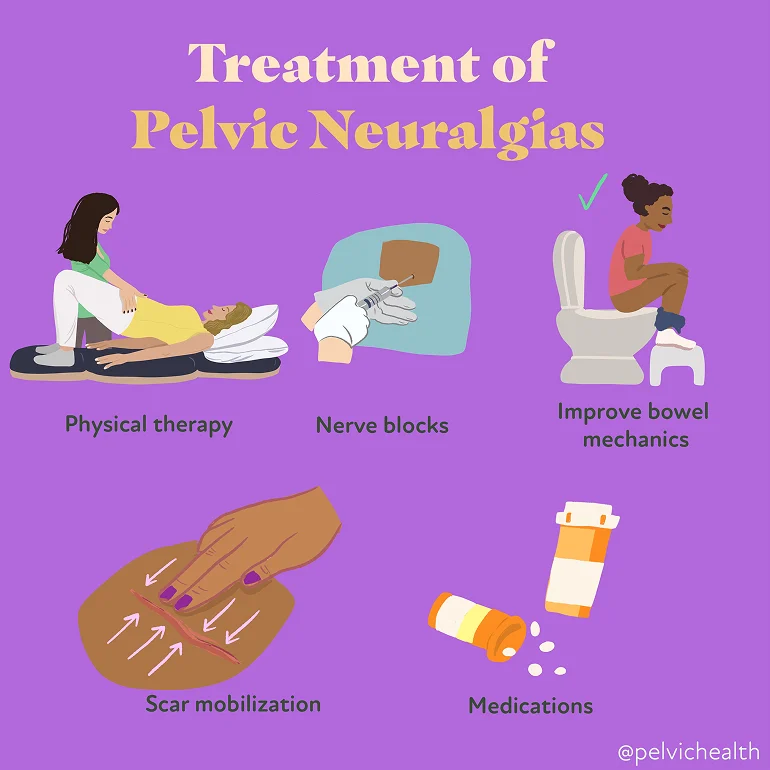 Trtments-pelvic-neuralgias