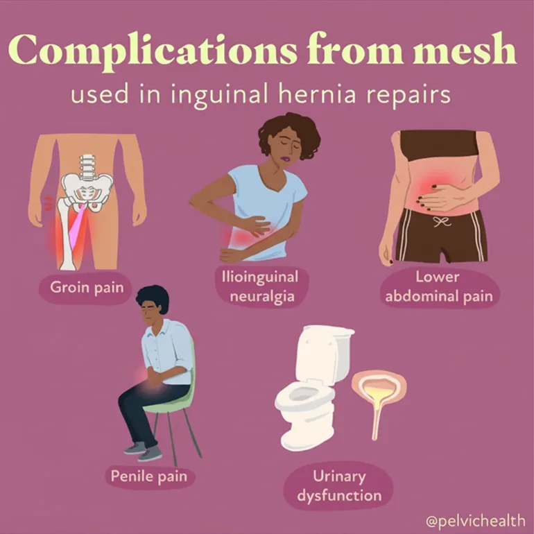 Complication-from-mesh